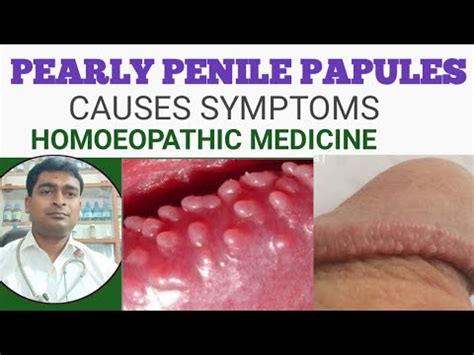 papule penienne|Pearly Penile Papules